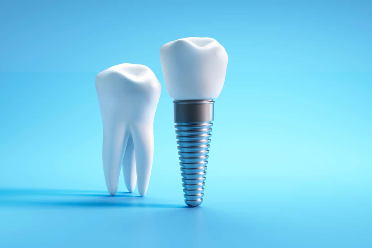 How much do dental implants cost in chickasha blog
