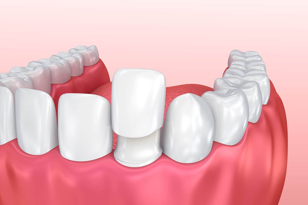 How to choose between veneers and bonding blog