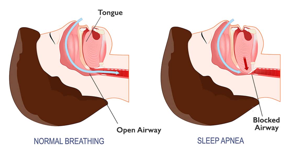 Sleep apnea diagram photo