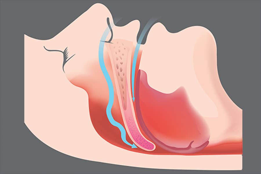 Sleep apnea illustration 900
