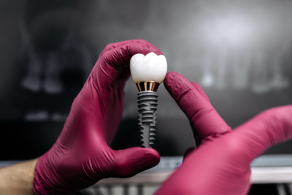 What the dental implant healing timeline looks like blog