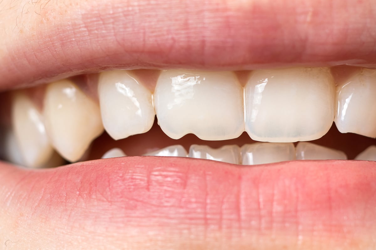 What to do if you chip a tooth before seeing a dentist blog